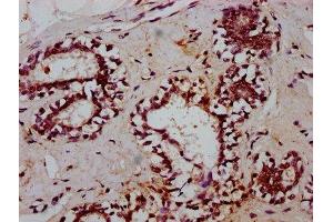 IHC image of ABIN7172427 diluted at 1:600 and staining in paraffin-embedded human breast cancer performed on a Leica BondTM system. (TCEA3 Antikörper  (AA 79-169))