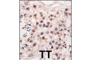 Formalin-fixed and paraffin-embedded human testicle tumor tissue reacted with HDAC11 antibody (C-term) (ABIN387965 and ABIN2844703) , which was peroxidase-conjugated to the secondary antibody, followed by DAB staining. (HDAC11 Antikörper  (C-Term))