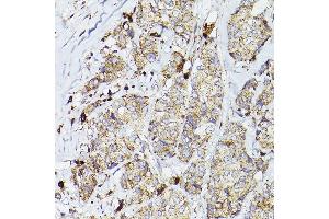 Immunohistochemistry of paraffin-embedded human breast cancer using PSAP Rabbit pAb (ABIN3022605, ABIN3022606, ABIN3022607, ABIN1513432 and ABIN6218938) at dilution of 1:50 (40x lens). (Prosaposin Antikörper  (AA 60-310))