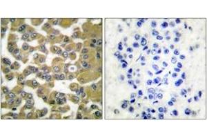 Immunohistochemistry analysis of paraffin-embedded human breast carcinoma tissue, using MMP-11 Antibody.