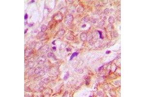 Immunohistochemical analysis of UBE3B staining in human breast cancer formalin fixed paraffin embedded tissue section. (UBE3B Antikörper)
