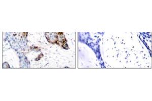 Immunohistochemical analysis of paraffin-embedded human breast carcinoma tissue using Estrogen Receptor-α (Ab-118) antibody (E021067). (Estrogen Receptor alpha Antikörper)