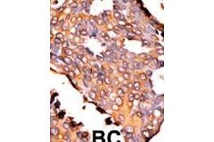 Formalin-fixed and paraffin-embedded human cancer tissue reacted with the primary antibody, which was peroxidase-conjugated to the secondary antibody, followed by AEC staining. (Riboflavin Kinase Antikörper  (N-Term))