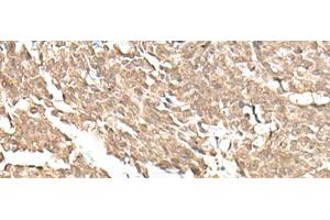 Immunohistochemistry of paraffin-embedded Human lung cancer tissue using KDM2A Polyclonal Antibody at dilution of 1:55(x200) (KDM2A Antikörper)