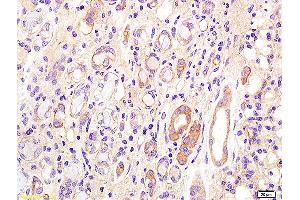 Formalin-fixed and paraffin embedded human kidney carcinoma labeled with Anti CD75 Polyclonal Antibody, Unconjugated (ABIN704201) at 1:200 followed by conjugation to the secondary antibody and DAB staining. (ST6GAL1 Antikörper  (AA 301-406))