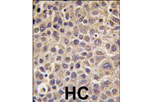 Immunohistochemistry (Formalin/PFA-fixed paraffin-embedded sections) of human hepatocellular carcinoma with MTMR9 polyclonal antibody , followed by peroxidase-conjugated secondary antibody and DAB staining. (MTMR9 Antikörper  (C-Term))