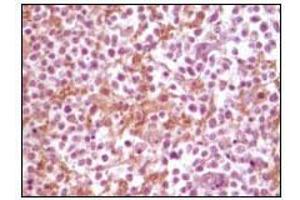 Immunohistochemical analysis of paraffin-embedded human glioma tissue, showing membrane localization using SNCA mouse mAb with DAB staining. (SNCA Antikörper)
