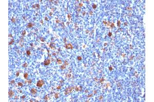 Formalin-fixed, paraffin-embedded human Hodgkin's Lymph stained with Fascin-1 Mouse Monoclonal Antibody (SPM133) (Fascin Antikörper)