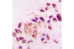 Immunohistochemical analysis of THRA staining in human lung cancer formalin fixed paraffin embedded tissue section.