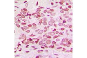 Immunohistochemical analysis of NF-kappaB p100 (pS865) staining in human breast cancer formalin fixed paraffin embedded tissue section. (NFKB2 Antikörper  (C-Term, pSer865))