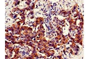 Immunohistochemistry of paraffin-embedded human bladder cancer using ABIN7161574 at dilution of 1:100