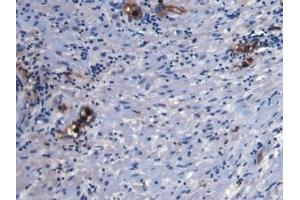 Detection of S100A8 in Human Prostate Tissue using Monoclonal Antibody to S100 Calcium Binding Protein A8 (S100A8) (S100A8 Antikörper  (AA 1-93))