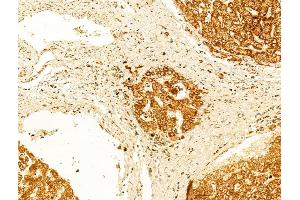 ABIN6262072 and ABIN6266555 at 1/100 staining Human normal tissues adjacent to liver cancer by IHC-P. (Granzyme B/H (N-Term) Antikörper)