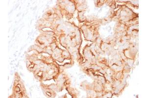 Formalin-fixed, paraffin-embedded human Ovarian Carcinoma stained with MUC16 Mouse Monoclonal Antibody (MUC16/1860).