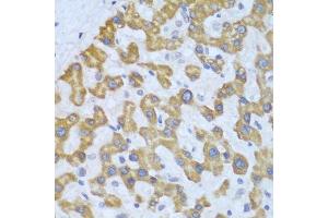 Immunohistochemistry of paraffin-embedded human liver cancer using PRKCD antibody. (PKC delta Antikörper  (AA 477-676))