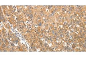 Immunohistochemistry of paraffin-embedded Human ovarian cancer using AKR1B1 Polyclonal Antibody at dilution of 1:30 (AKR1B1 Antikörper)