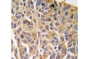 IHC analysis of FFPE human lung carcinoma tissue stained with RIPK3 antibody (RIPK3 Antikörper  (AA 1-30))