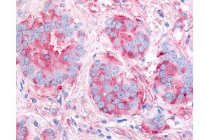Anti-KDR / VEGFR2 antibody IHC of human Breast, Carcinoma. (VEGFR2/CD309 Antikörper  (Internal Region))