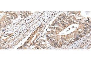 Immunohistochemistry of paraffin-embedded Human colorectal cancer tissue using ATF6B Polyclonal Antibody at dilution of 1:30(x200) (ATF6B Antikörper)