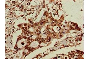 Immunohistochemistry of paraffin-embedded human pancreatic cancer using ABIN7151588 at dilution of 1:100 (ELP6 Antikörper  (AA 95-195))