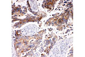 Anti-SLC16A4 antibody, IHC(P) IHC(P): Human Mammary Cancer Tissue (SLC16A4 Antikörper  (N-Term))