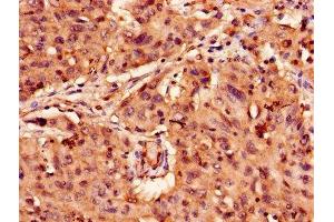 Immunohistochemistry of paraffin-embedded human lung cancer using ABIN7144485 at dilution of 1:100 (APAF1 Antikörper  (AA 104-415))
