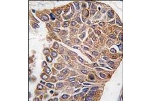 Formalin-fixed and paraffin-embedded human lung carcinoma tissue reacted with AKT2 antibody (C-term), which was peroxidase-conjugated to the secondary antibody, followed by DAB staining. (AKT2 Antikörper  (C-Term))