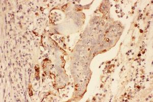 Anti-MMP7 Picoband antibody,  IHC(P): Human Intestinal Cancer Tissue (MMP7 Antikörper  (AA 1-267))