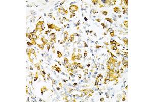 Immunohistochemistry of paraffin-embedded human gastric cancer using TAPBP Antibody (ABIN6132745, ABIN6148848, ABIN6148850 and ABIN6219122) at dilution of 1:200 (40x lens). (TAPBP Antikörper  (AA 30-260))