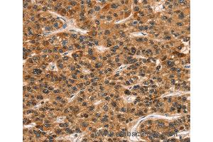 Immunohistochemistry of Human gastric cancer using KLRC1 Polyclonal Antibody at dilution of 1:30 (CD159a/c Antikörper)