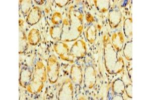 Immunohistochemistry of paraffin-embedded human gastric cancer using ABIN7175053 at dilution of 1:100 (KIAA1324-Like Antikörper  (AA 227-526))