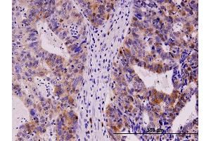 Immunoperoxidase of monoclonal antibody to TYMS on formalin-fixed paraffin-embedded human stomach carcinoma.
