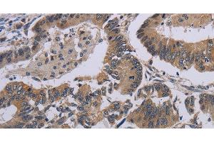Immunohistochemistry of paraffin-embedded Human colon cancer tissue using CCL1 Polyclonal Antibody at dilution 1:50 (CCL1 Antikörper)