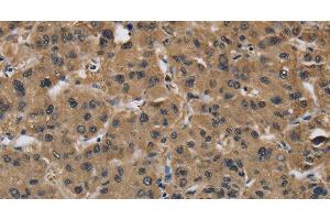 Immunohistochemistry of paraffin-embedded Human liver cancer using FABP2 Polyclonal Antibody at dilution of 1:40 (FABP2 Antikörper)