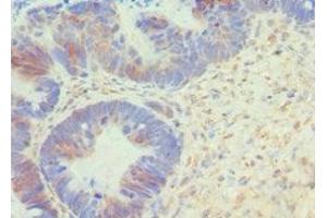 Immunohistochemistry of paraffin-embedded human ovarian cancer using ABIN7145167 at dilution of 1:100 (Cyclin D1 Antikörper  (AA 1-233))
