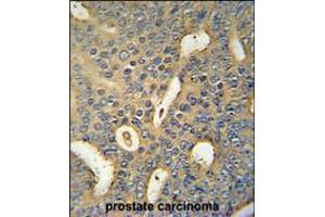 MICALL1 Antibody immunohistochemistry analysis in formalin fixed and paraffin embedded human prostate carcinoma followed by peroxidase conjugation of the secondary antibody and DAB staining.