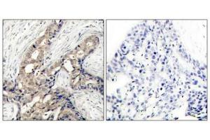 Immunohistochemical analysis of paraffin-embedded human breast carcinoma tissue using c-Abl (phospho-Tyr412) antibody. (ABL1 Antikörper  (pTyr412))