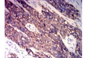 Immunohistochemical analysis of paraffin-embedded ewing sarcoma tissues using CD99 mouse mAb with DAB staining. (CD99 Antikörper  (AA 1-185))