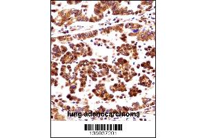 ORC3L Antibody immunohistochemistry analysis in formalin fixed and paraffin embedded human lung adenocarcinoma followed by peroxidase conjugation of the secondary antibody and DAB staining. (ORC3 Antikörper  (N-Term))