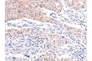 The image on the left is immunohistochemistry of paraffin-embedded Human lung cancer tissue using ABIN7192139(RalA Antibody) at dilution 1/20, on the right is treated with synthetic peptide. (rala Antikörper)