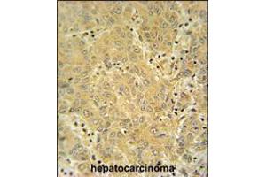 CYP2A7 antibody immunohistochemistry analysis in formalin fixed and paraffin embedded human hepatocarcinoma followed by peroxidase conjugation of the secondary antibody and DAB staining. (CYP2A7 Antikörper  (AA 121-148))