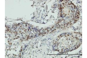 Immunoperoxidase of monoclonal antibody to RNMT on formalin-fixed paraffin-embedded human squamous cell carcinoma tissue.