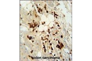 WDR21C antibody (N-term) (ABIN654576 and ABIN2844279) immunohistochemistry analysis in formalin fixed and paraffin embedded human colon carcinoma followed by peroxidase conjugation of the secondary antibody and DAB staining. (DCAF4L2 Antikörper  (N-Term))