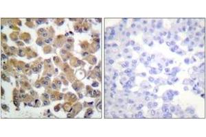 Immunohistochemistry analysis of paraffin-embedded human breast carcinoma tissue, using TGF beta1 Antibody.