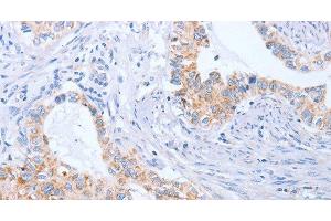 Immunohistochemistry of paraffin-embedded Human cervical cancer tissue using BST1 Polyclonal Antibody at dilution 1:50 (BST1 Antikörper)