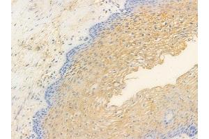 ABIN6256645 and ABIN6267481 at 1/100 staining human cervical carcinoma by IHC-P.