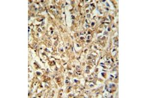 Formalin fixed, paraffin embedded breast carcinoma reacted with DDX6 Antibody (Center) followed by peroxidase conjugation of the secondary antibody and DAB staining. (DDX6 Antikörper  (Middle Region))