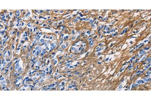 Immunohistochemistry of paraffin-embedded Human prostate cancer tissue using COL3A1 Polyclonal Antibody at dilution 1:60 (COL3A1 Antikörper)