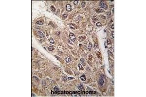 Formalin-fixed and paraffin-embedded human hepatocarcinoma tissue reacted with BICD2 antibody (C-term) (ABIN392178 and ABIN2841891) , which was peroxidase-conjugated to the secondary antibody, followed by DAB staining. (BICD2 Antikörper  (C-Term))