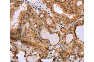 Immunohistochemistry of Human thyroid cancer using EPDR1 Polyclonal Antibody at dilution of 1:40 (EPDR1 Antikörper)